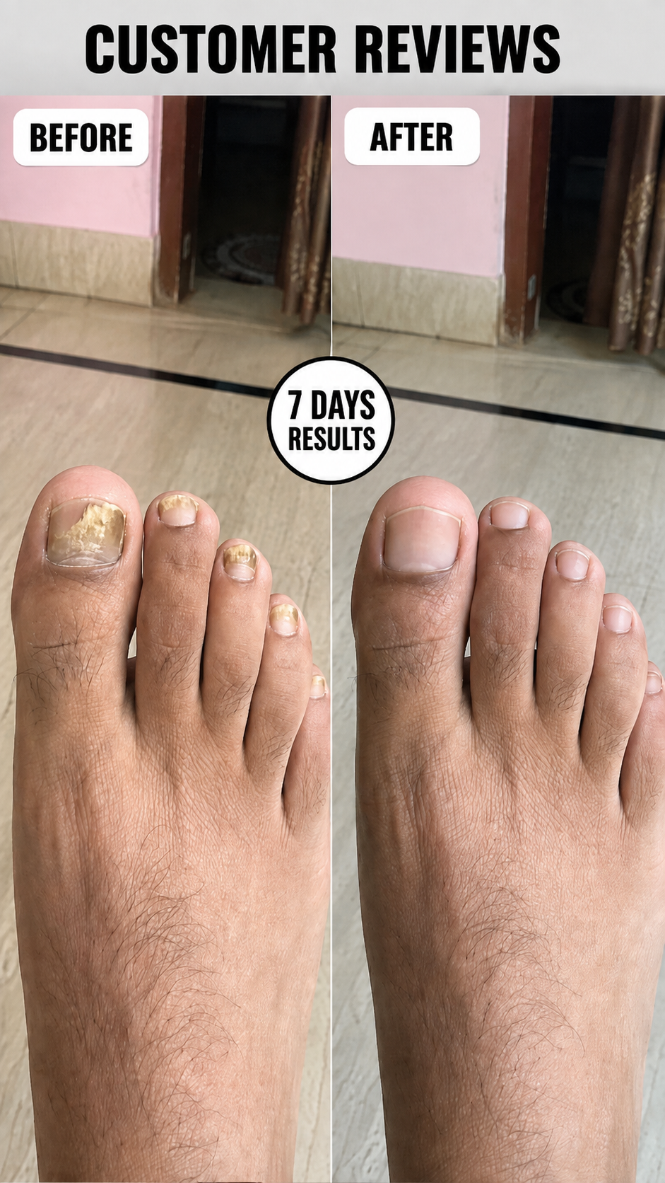 Anti Paronychia Relief Nail Oil - Buy 1 Get 1 FREEš„