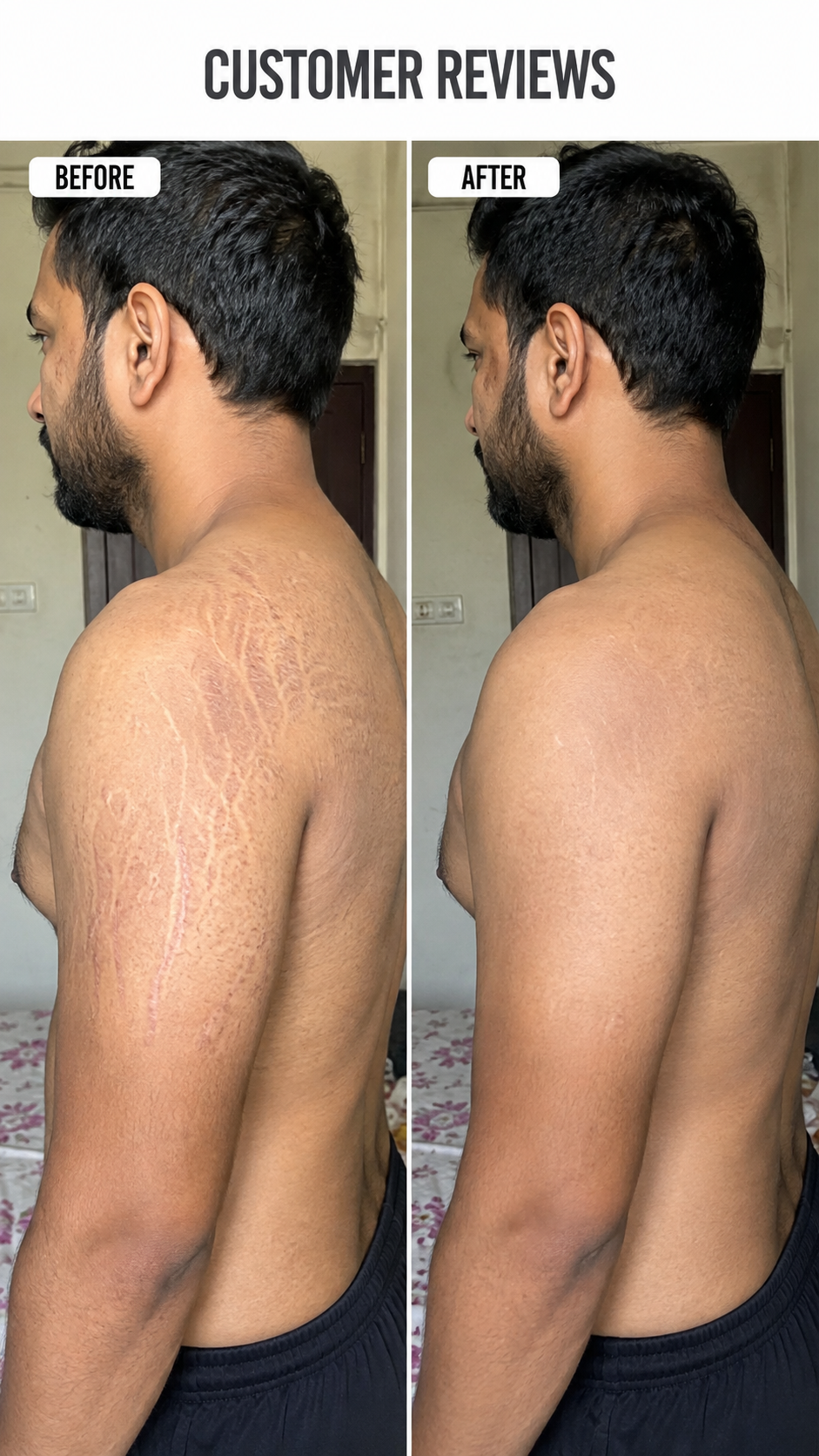 Stretchgo  Stretchmark Removal Herbal Oil