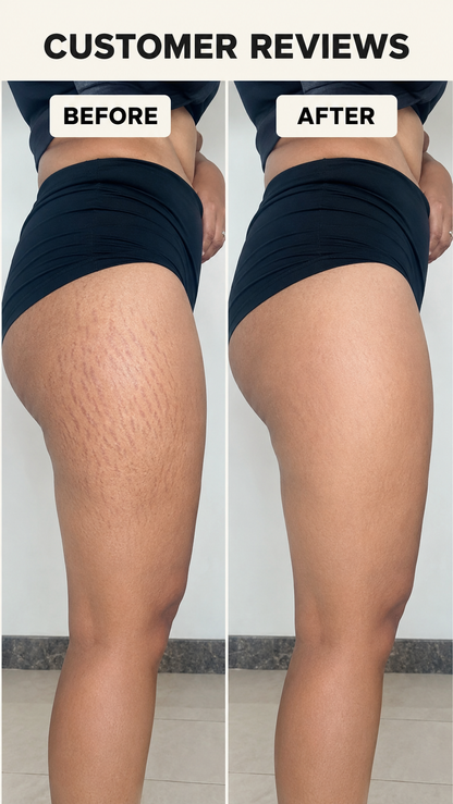 Stretchgo  Stretchmark Removal Herbal Oil