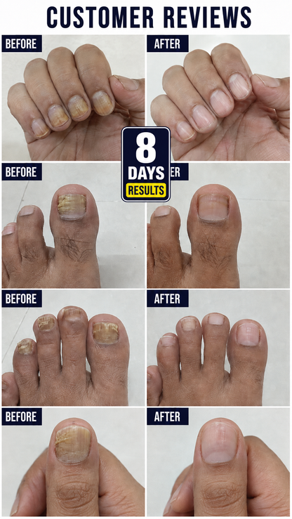 Anti Paronychia Relief Nail Oil - Buy 1 Get 1 FREE🔥