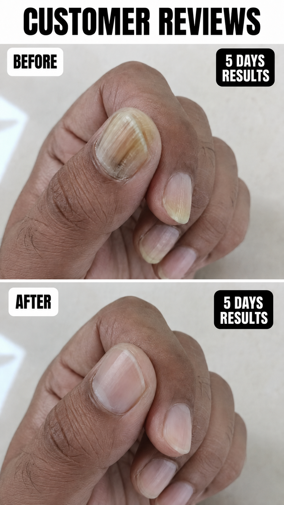 Anti Paronychia Relief Nail Oil - Buy 1 Get 1 FREE🔥