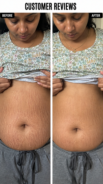 Stretchgo  Stretchmark Removal Herbal Oil