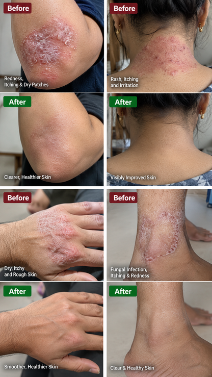 Eczemaron Anti-Fungal Spray-🔥 BUY 1 GET 1 FREE 🔥