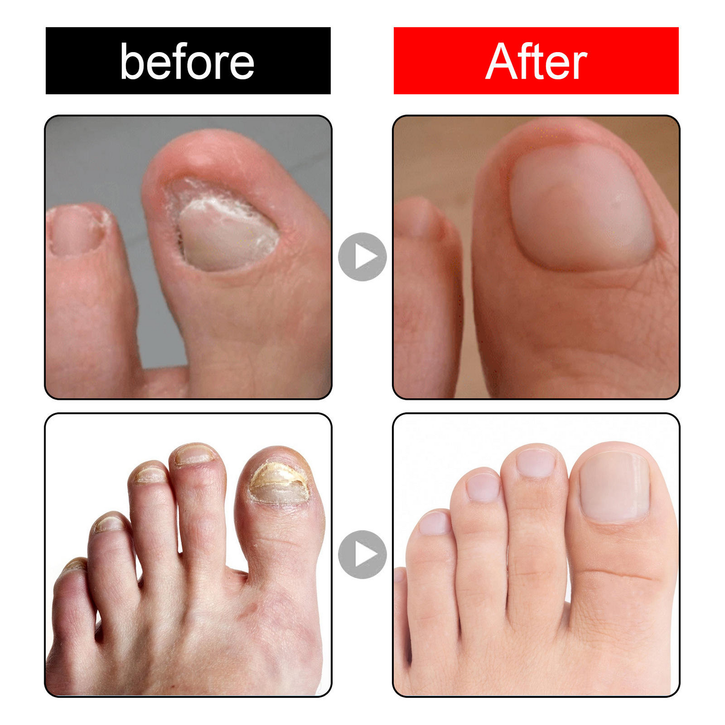 Toenail Nail Repair Oil for Damaged & Weak Nails – Buy 1 Get 1 FREE 🔥
