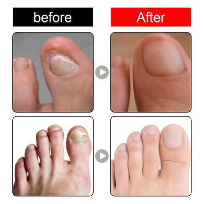 Toenail Nail Repair Oil for Damaged & Weak Nails – Buy 1 Get 1 FREE 🔥