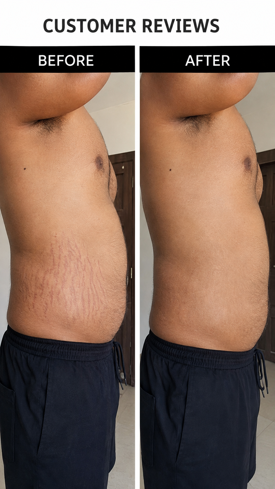 Stretchgo  Stretchmark Removal Herbal Oil