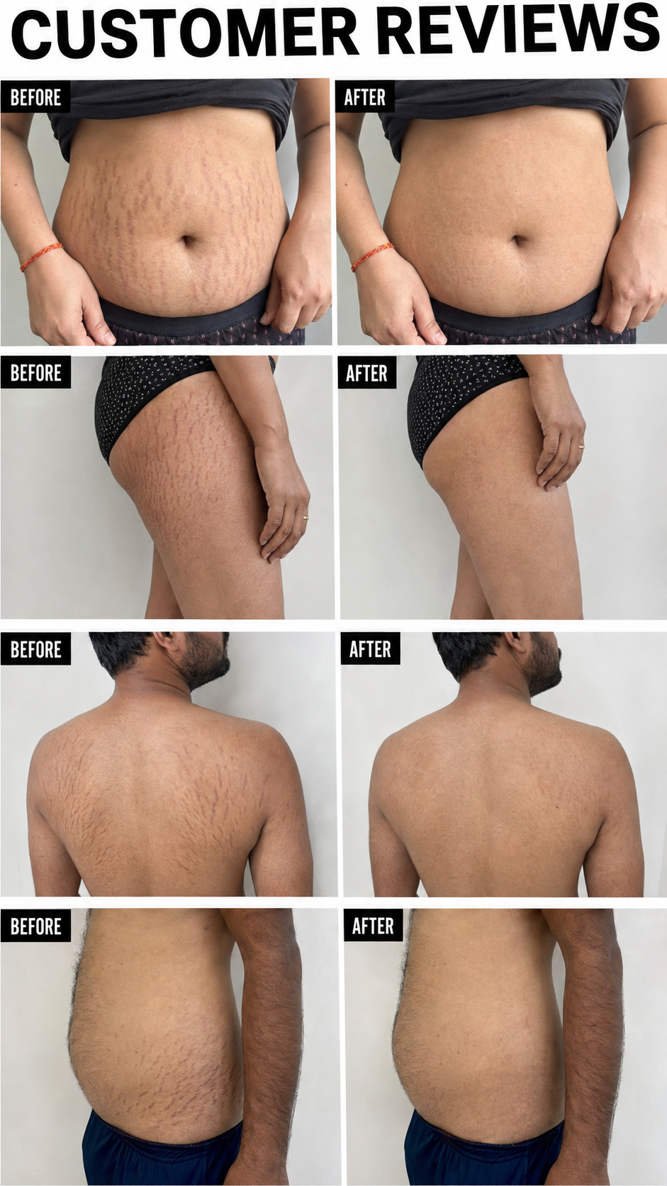 Stretchgo  Stretchmark Removal Herbal Oil